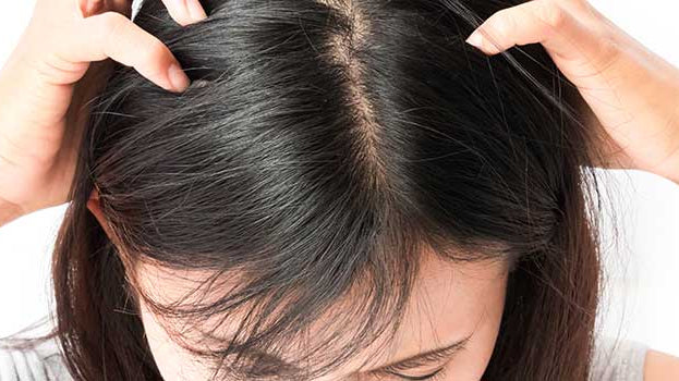 Nissen oder Schuppen