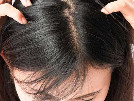 Nissen oder Schuppen