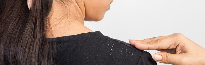 Frau mit trockener Kopfhaut und Schuppen